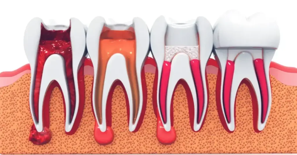 Root Canals